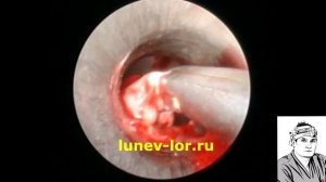 Удаление кисты верхнечелюстной пазухи (полная операция) 14032018 С