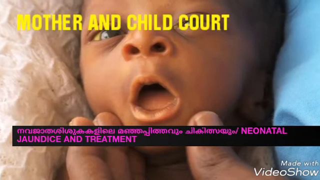 Neonatal jaundice/നവജാതശിശുകകളിലെ മഞ്ഞപ്പിത്തം ചികിത്സയും ( മലയാളത്തിൽ) смотреть онлайн
