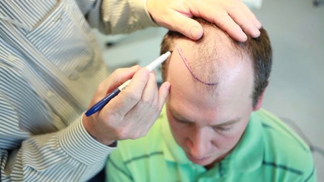 Diary of a hair transplant смотреть онлайн