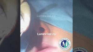 Септопластика. Установка силиконовых сплинтов.