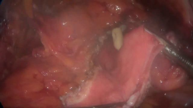 Laparoscopic Boari flap смотреть онлайн