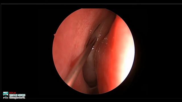 Replay Webinar | Trucs & Astuces | Chirurgie des voies lacrymales | 10 mars 2021 смотреть онлайн