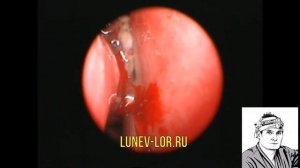 Рассечение синехии полости носа лазером под эндоскопическим контролем 03092018 С