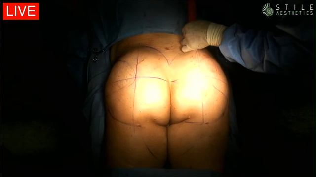 Live Brazilian Butt Lift | Butt Augmentation
