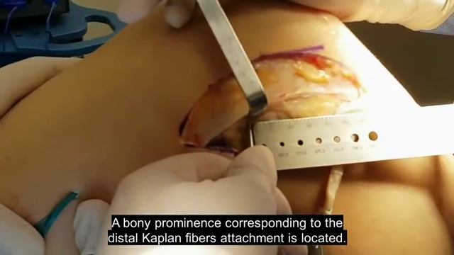 Capsulo-osseous Layer Retensioning and Distal Kaplan Fiber Surgical Reconstruction... смотреть онлайн
