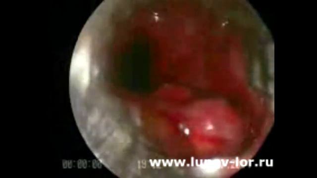 Удаление кисты верхнечелюстной пазухи (эндоскопическая часть операции) 2