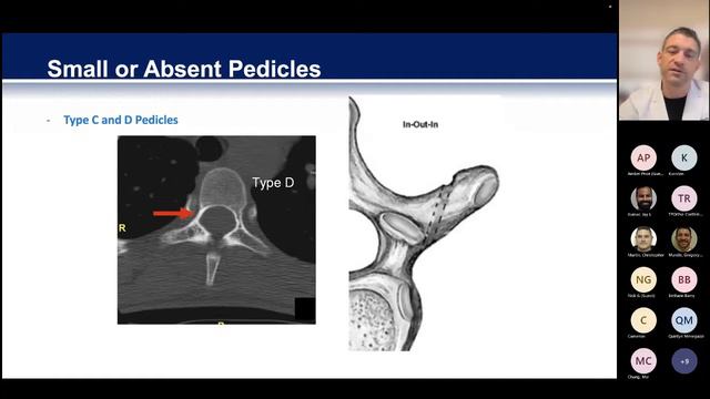 Open Pedicle Screw Placement Presented By Gregory M. Mundis, Jr., MD
