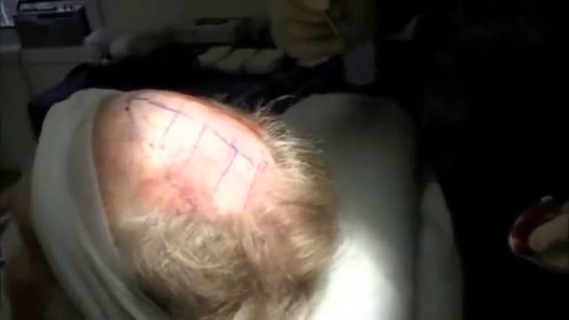 The Quest for Hair - Dr. William Lindsey смотреть онлайн