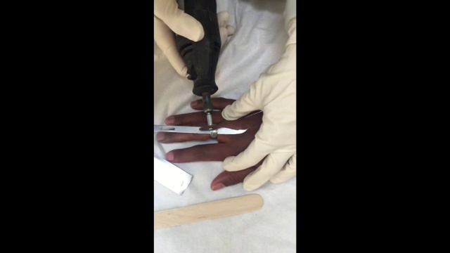 Emergency Department Ring Removal With Dremel Tool