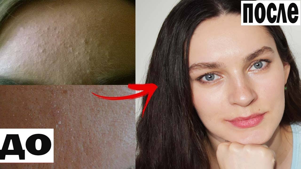 ИДЕАЛЬНАЯ КОЖА БЕЗ РЕЛЬЕФА ошибки в уходе лучшие средства для нашей кожи СВОИМИ РУКАМИ смотреть онлайн