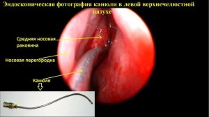 Лечение гайморита без прокола. Зондирование верхнечелюстных пазух через естественное соустье.