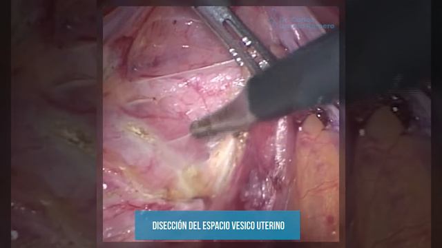 Histerectomía total laparoscópica N°226 l Dr. Carlos Urrutia Romero смотреть онлайн
