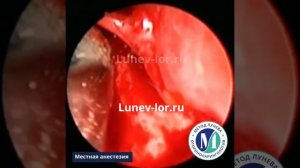 Удаление инородного тела из верхнечелюстной пазухи.Инфратурбинальный доступ.