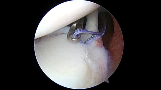 SLAP Repair смотреть онлайн