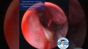 Удаление кист правой верхнечелюстной пазухи. Инфратурбинальный доступ.