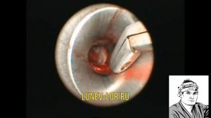 Эндоскопическая микрогайморотомия удаление кисты верхнечеюстной пазухи 04092018 С