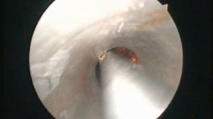 Удаление кисты верхнечелюстной пазухи эндоскопическая часть операции 1