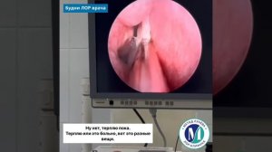 Удаление полипа носа лазером и шейвером под местной анестезией.