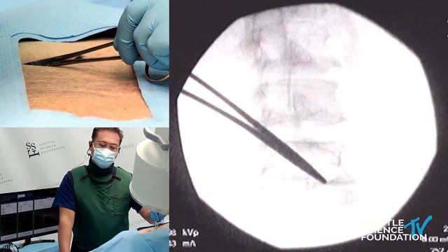 Lumbar and Cervical Medial Branch Neurotomy - Glen David M.D. смотреть онлайн