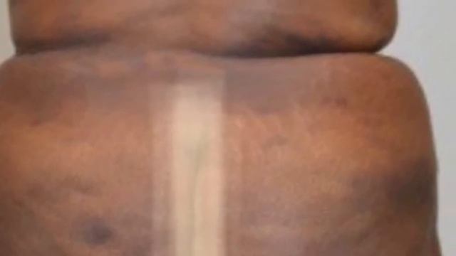 Brazilian Butt Lift, BBL, Plastic Surgery Butcher Adam Rubinstein Of Miami, Bad Work, No Talent