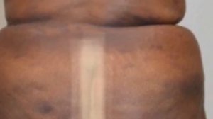 Brazilian butt lift, BBL, Plastic Surgery butcher Adam Rubinstein of Miami, bad work, No talent