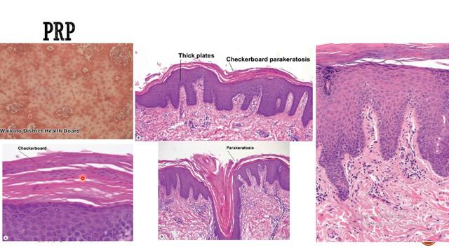 2- Psoriasiform Dermatoses - DD (1) смотреть онлайн
