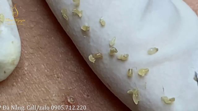 Remove whiteheads and acne on the nose (72) | Loan Nguyen смотреть онлайн