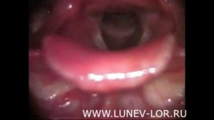 Непрямая ларингоскопия гортани без патологии