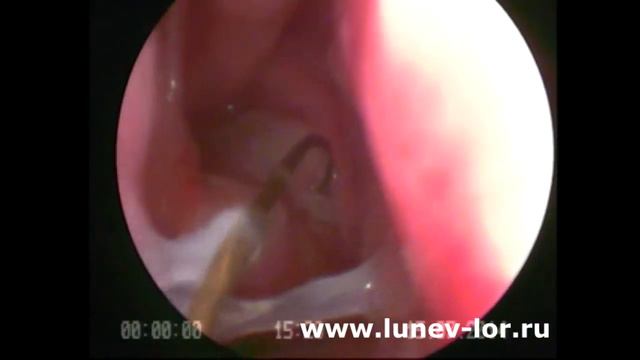 Удаление хоанальных полипов