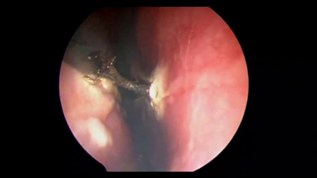Endoscopic Excision Of Pituitary Tumour-Dr Harish Naik( J J Hospital Mumbai)