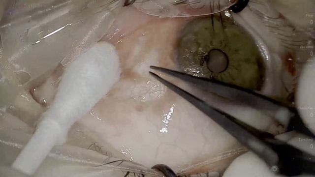 Anton Angelov pterygium surgery Vista Live Stream смотреть онлайн