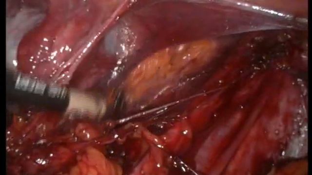 Doç.Dr.Hüsnü ÇELİK LAPAROSKOPİK PELVİK LENF NODU DİSEKSİYONU смотреть онлайн