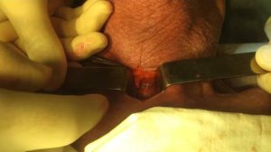 Трахеостомия