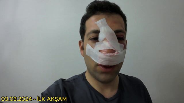 ÖLÜMDEN DÖNDÜĞÜM KAZA | Başıma Neler Geldi? Parçalı Burun Kırığı, İlk Yardımın Önemi, 112 Ambulans смотреть онлайн