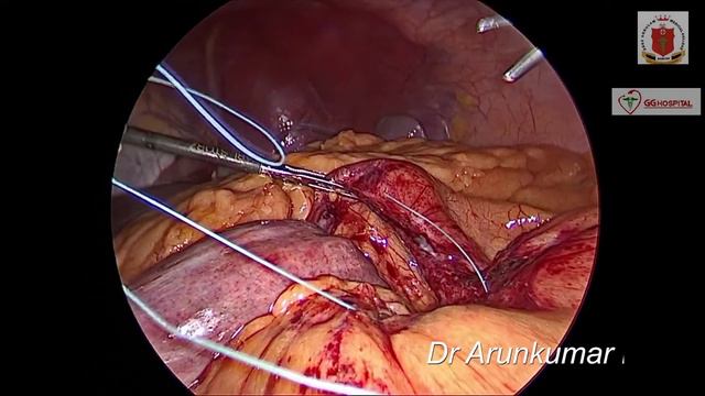 left paraduodenal hernia смотреть онлайн