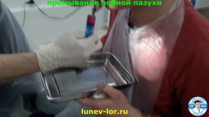 Фронтит. Зондирование лобной пазухи через естественное соустье.