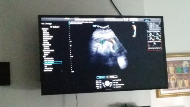 Full Term Ultrasound смотреть онлайн