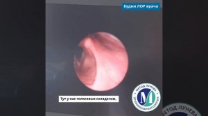Фиброларингоскопия - детальный осмотр всех отделов гортани с видеозаписью.