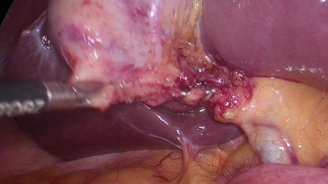 Безопасная холецистэктомия. Critical View Of Safety. Критерии Страсберга