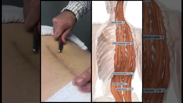 Using Graston Tools to Combat 10/10 Back Pain смотреть онлайн