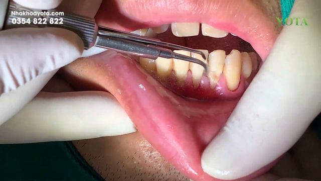 Cận cảnh lấy cao răng khủng lâu năm | Đại Tá BS Tuệ смотреть онлайн