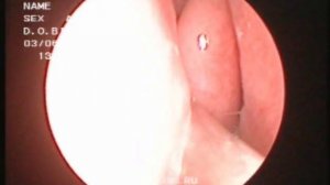 Удаление полипа носа петлей под контролем оптики