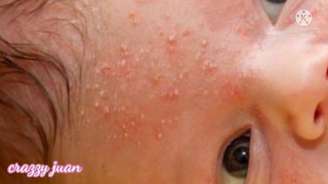 Natural home remedies to cure heat rashes on babies in malayalam/കുഞ്ഞുങ്ങളിലെ ചൂടുകുരു മാറാൻ... смотреть онлайн