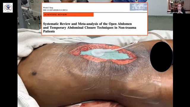 Trauma Abdominal SOCICH смотреть онлайн