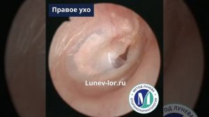 Отоскопия. Перфорация барабанной перепонки