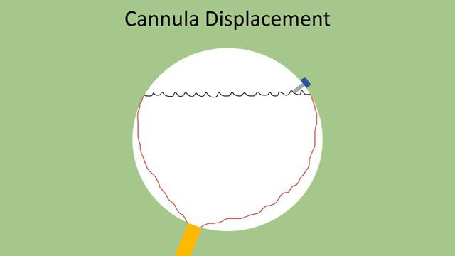 Infusion cannula malpositioning/retraction into subretinal space exacerbating retinal detachment смотреть онлайн