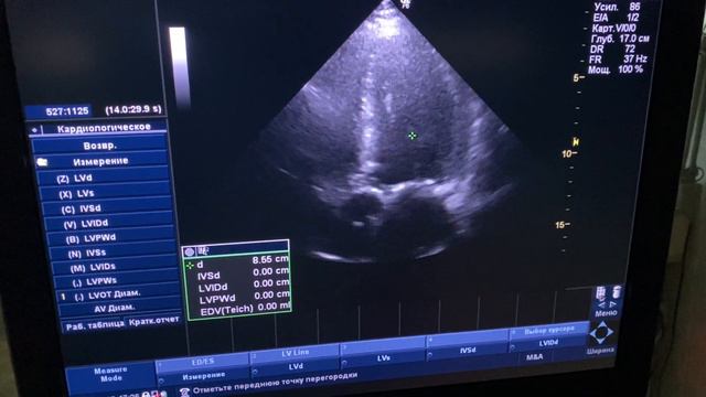 Практическое занятие 09-02-2022 №3. Аортальный стеноз.  Расчет площади стеноза. О.Л. Ерошенко.