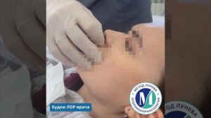 Зондирование лобной пазухи при гнойном фронтите.
