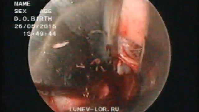 Septum операция Подслизистая резекция перегородки носа