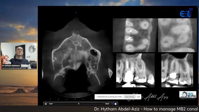 Dr. Hytham Abdel-Aziz - how to manage MB2 canal смотреть онлайн